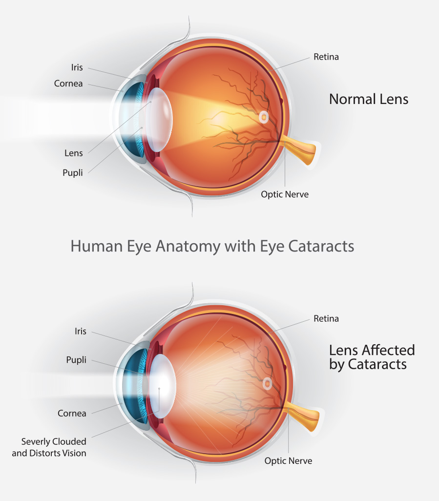 Cataract-Eye-Anatomy Pennwood Ophthalmic Associates, PC